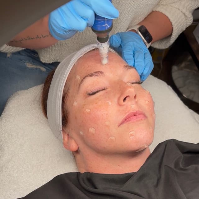 Microneedling Face (Package of 6) at Haley Copeland Esthetics in Knoxville, TN